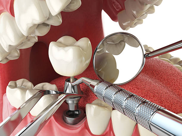 Best Emergency Wisdom Tooth Extraction in Bethel, OH